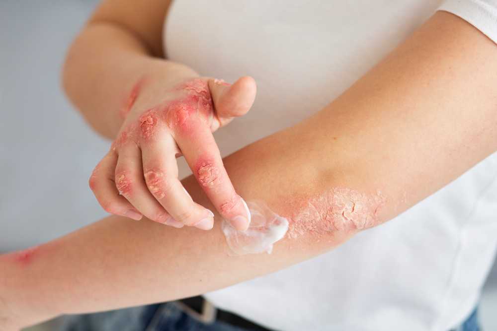 Psoriáza jak ji poznat a léčit 